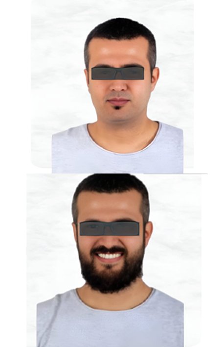 beard-hair-transplant-service