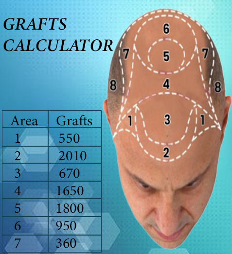 shami-hair-transplant-latest