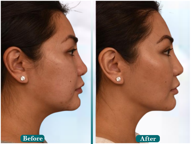 Male-hair-transplant