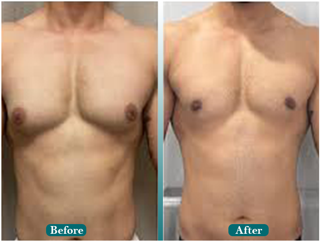 Male-hair-transplant