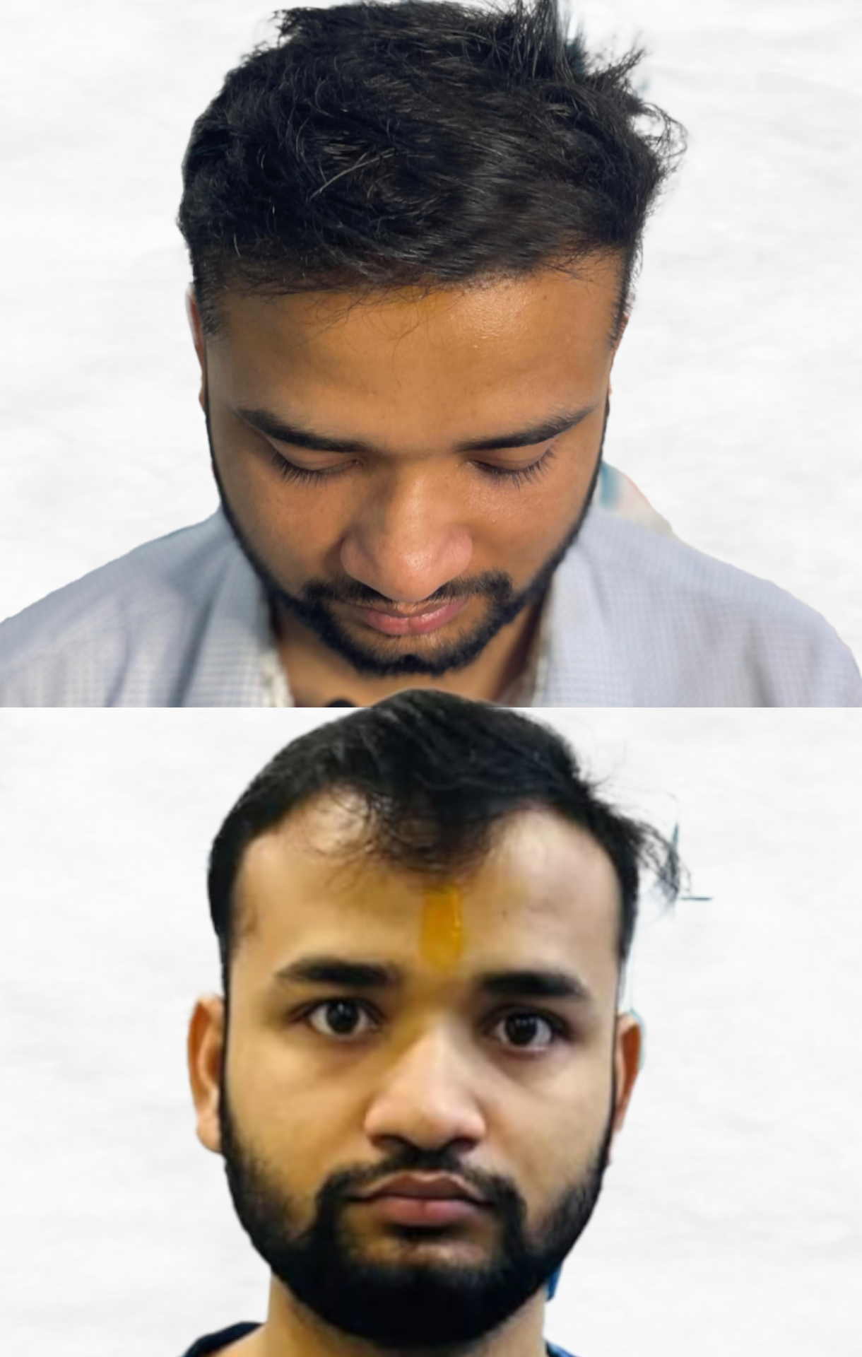 shami-hair-transplant-latest
